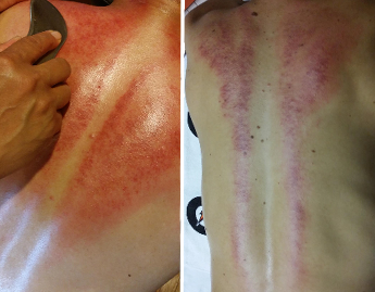 Gua Sha Therapy